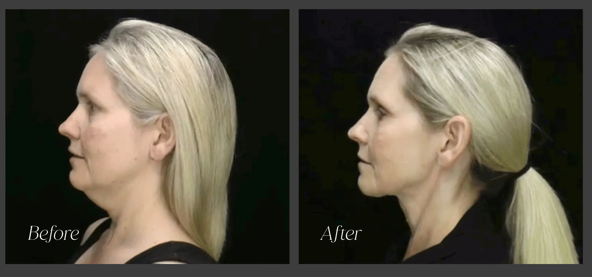 Before and after images of a woman that had the MyEllevate procedure done