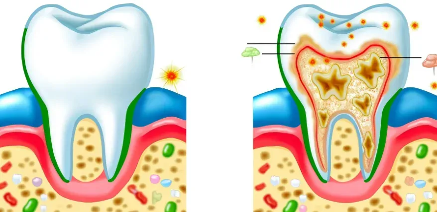 A split image showing the benefits of fluoride toothpaste on one side and the effects of dietary changes on the other. 