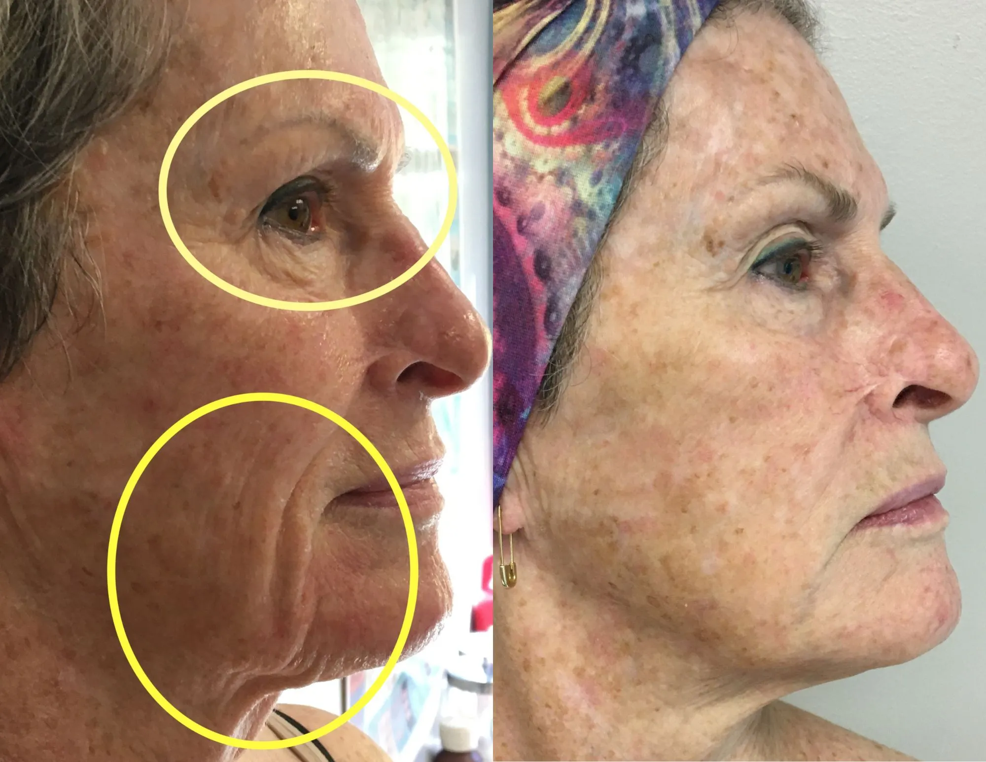 Microneedling before & after 2