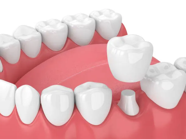 dental crowns Queens NY