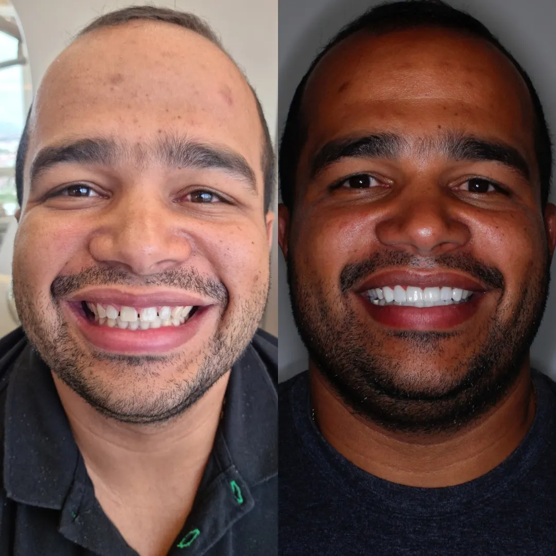 facetas dentarias neocare niteroi